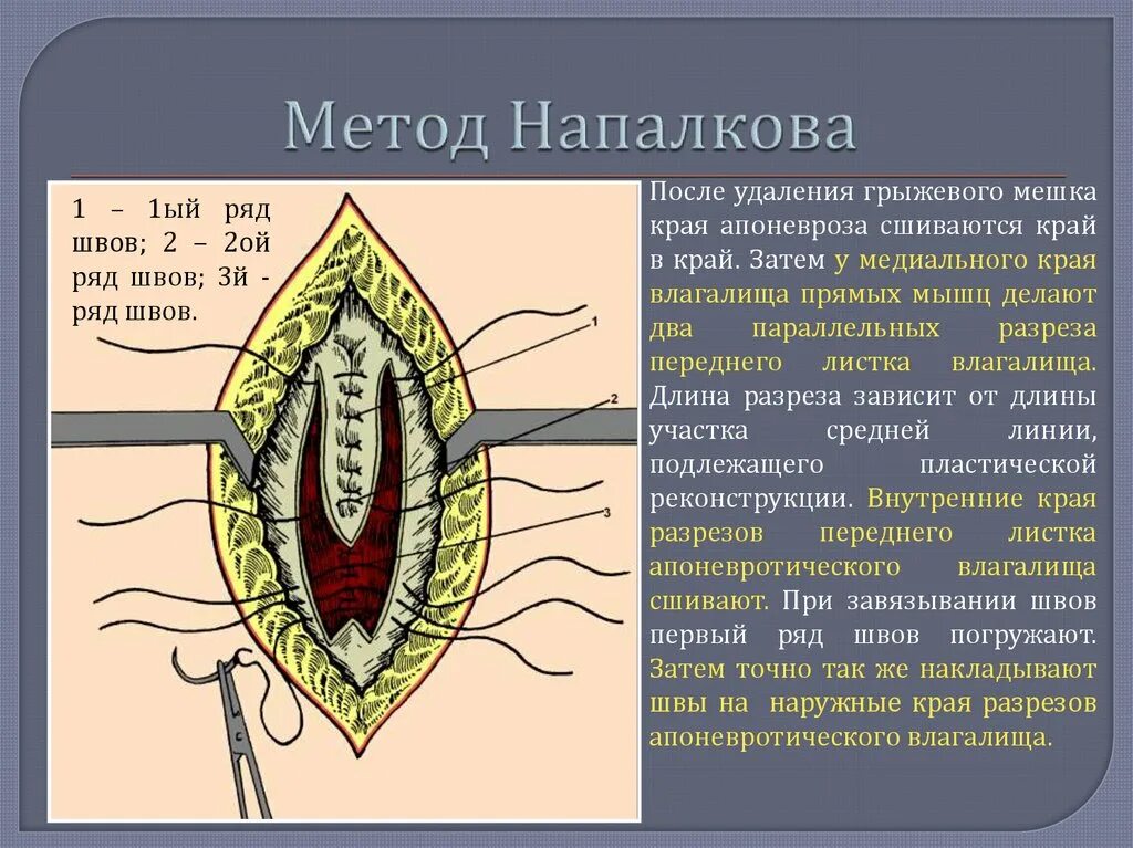 Послеоперационные фото грыжи белой линии живота Картинки ПЛАСТИКА ГРЫЖИ ЖИВОТА