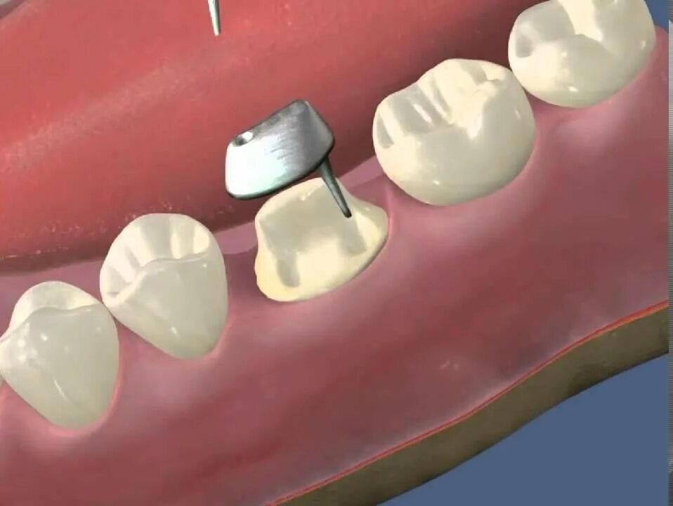 Поставить коронку на зуб фото Установка титановой вкладки в Москве
