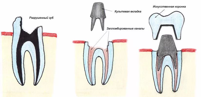 Поставить коронку на зуб фото Восстановление зубов