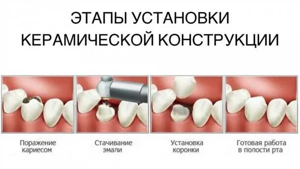 Поставить коронку на зуб фото Как правильно ставят коронку на зуб? Медицинская Энциклопедия