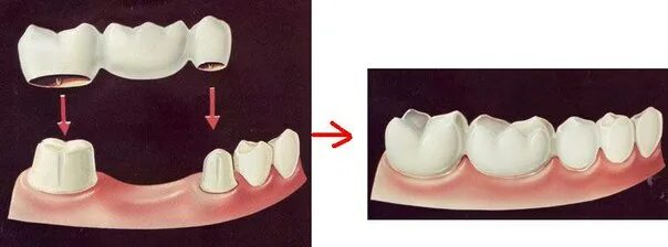 Поставить коронку на зуб фото Картинки ПОСТАВИТЬ КОРОНКУ НА ЗУБЫ ГДЕ МОЖНО