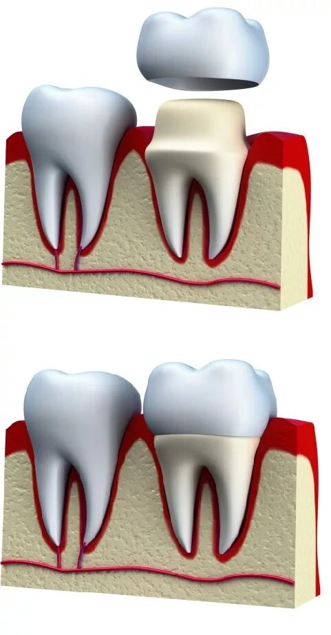 Поставить коронку на зуб фото Как одевается коронка на зуб Foto-Leto.ru