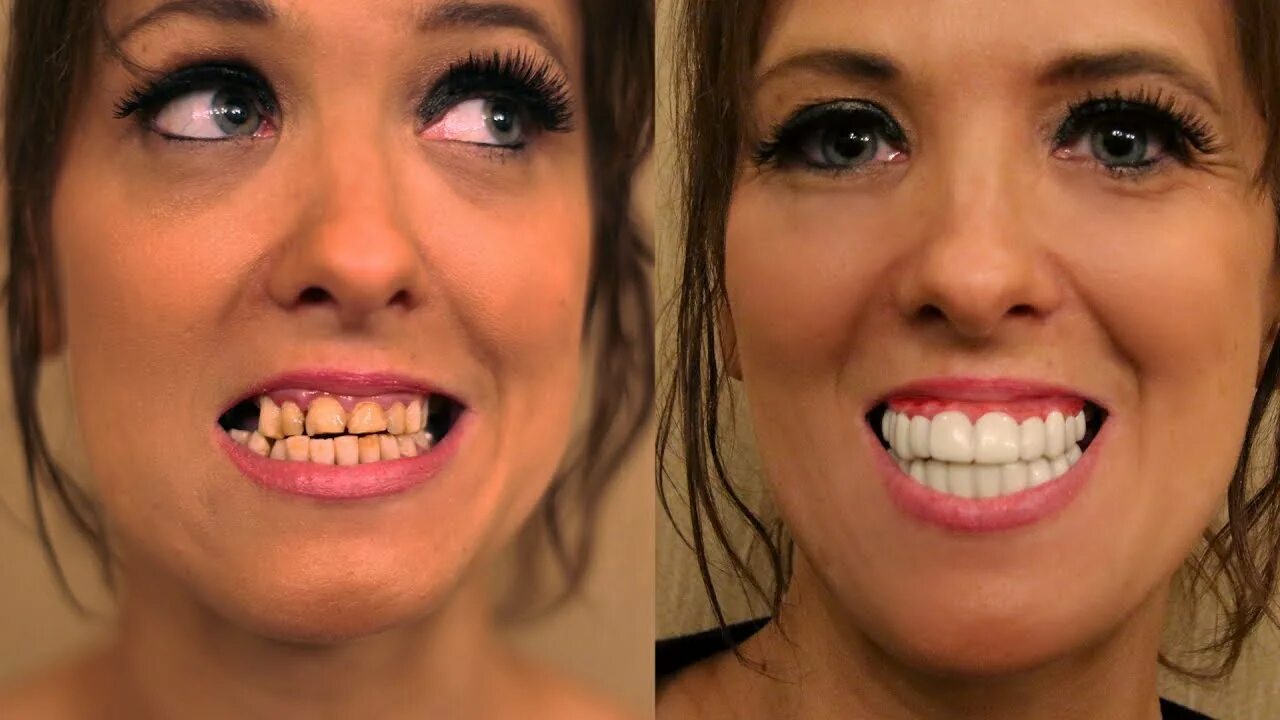 Поставить зубы фото Porcelain Veneers were SMASHED in a FIGHT! See Makeover by Brighter Image Lab - 