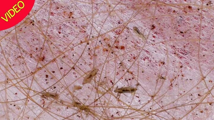 Постельная вша фото укусов Health experts issue head lice warning as kids go back to school - Irish Mirror 