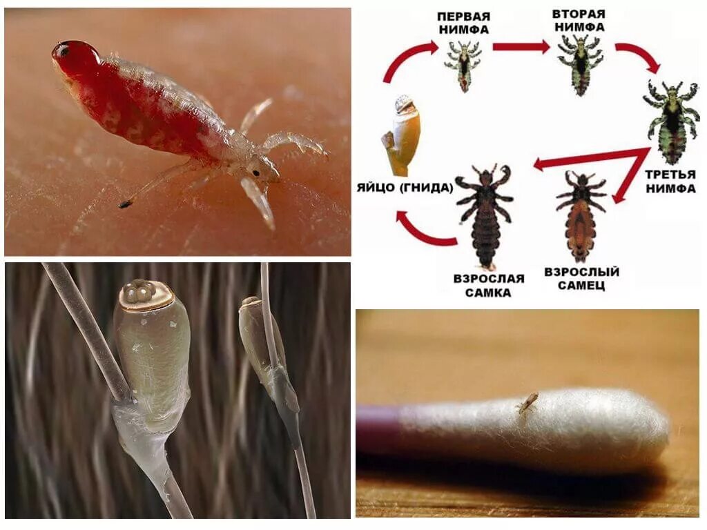 Постельные вши укусы как выглядят на теле Укусы вшей на теле и голове человека, фото