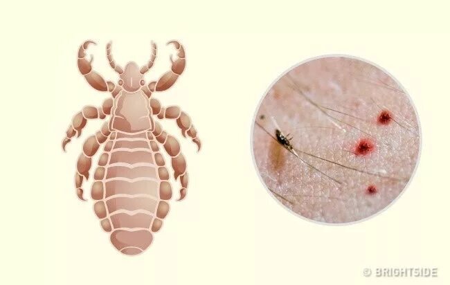 Постельные вши укусы как выглядят на теле 10 Bug Bites Anyone Should Be Able to Identify Bug bites, Insect bites, Bugs