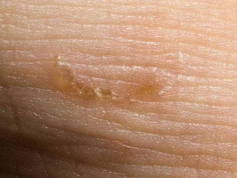 Постскабиозный дерматит фото Scabies Stratum Dermatology Clinics