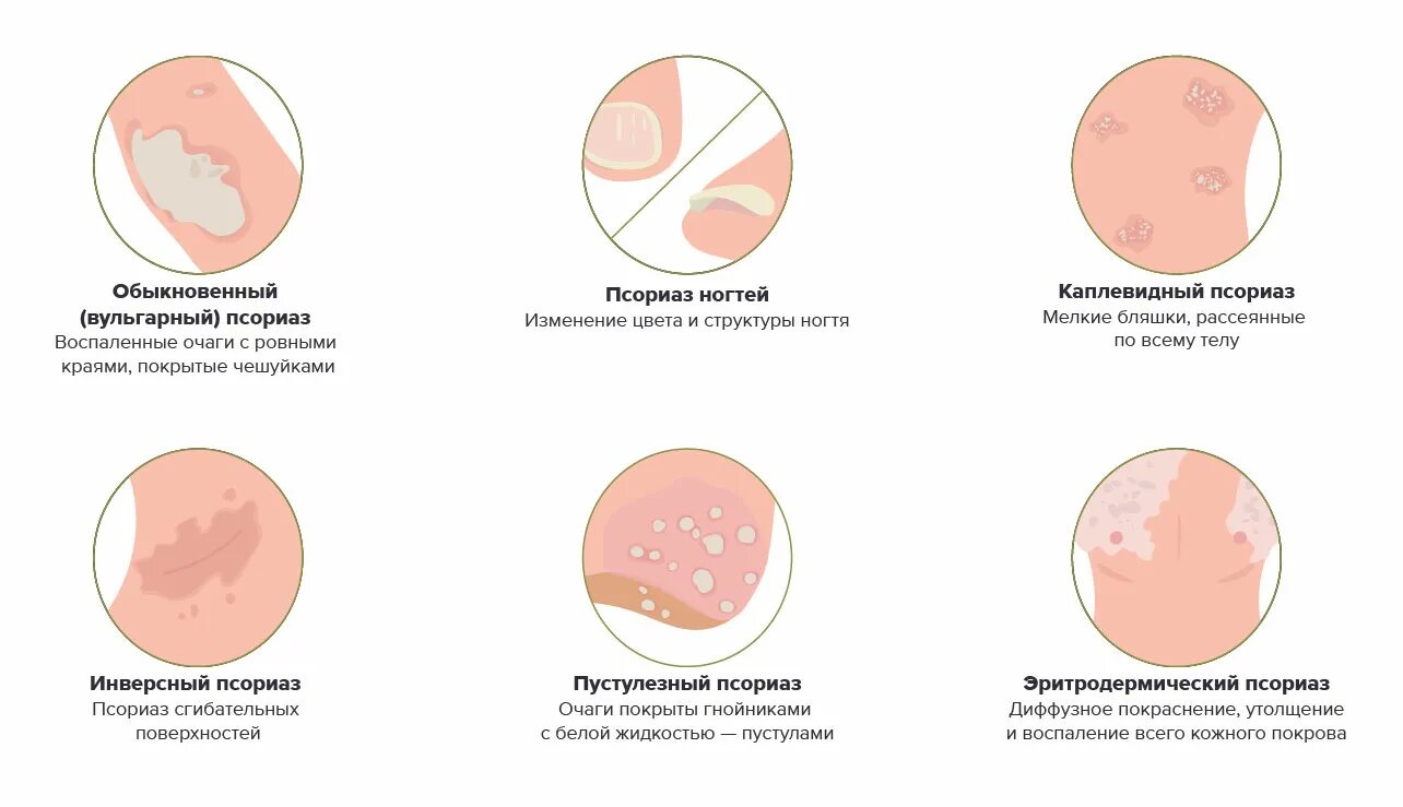 Постскабиозный дерматит фото и описание Псориаз на руках - Vitimed