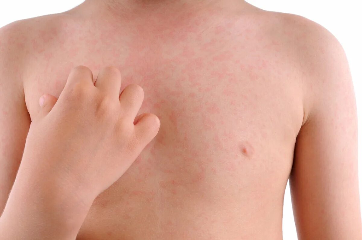 Dupilumab Significantly Decreased Itch and Hives in Patients with Chronic Sponta