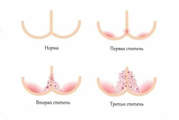 Потничка у взрослых симптомы и лечение фото Пеленочный дерматит: причины, симптомы и лечение в статье аллерголога Столярова 