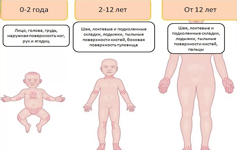 Потничка у взрослых симптомы и лечение фото Как отличить потницу от аллергии у грудничка: 13 отличий, симптомы, советы по ух