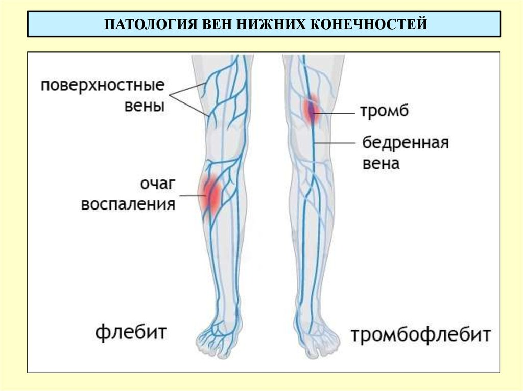 Поверхностный тромбофлебит нижних конечностей фото Чем отличаются флебит и тромбофлебит: ответ флеболога