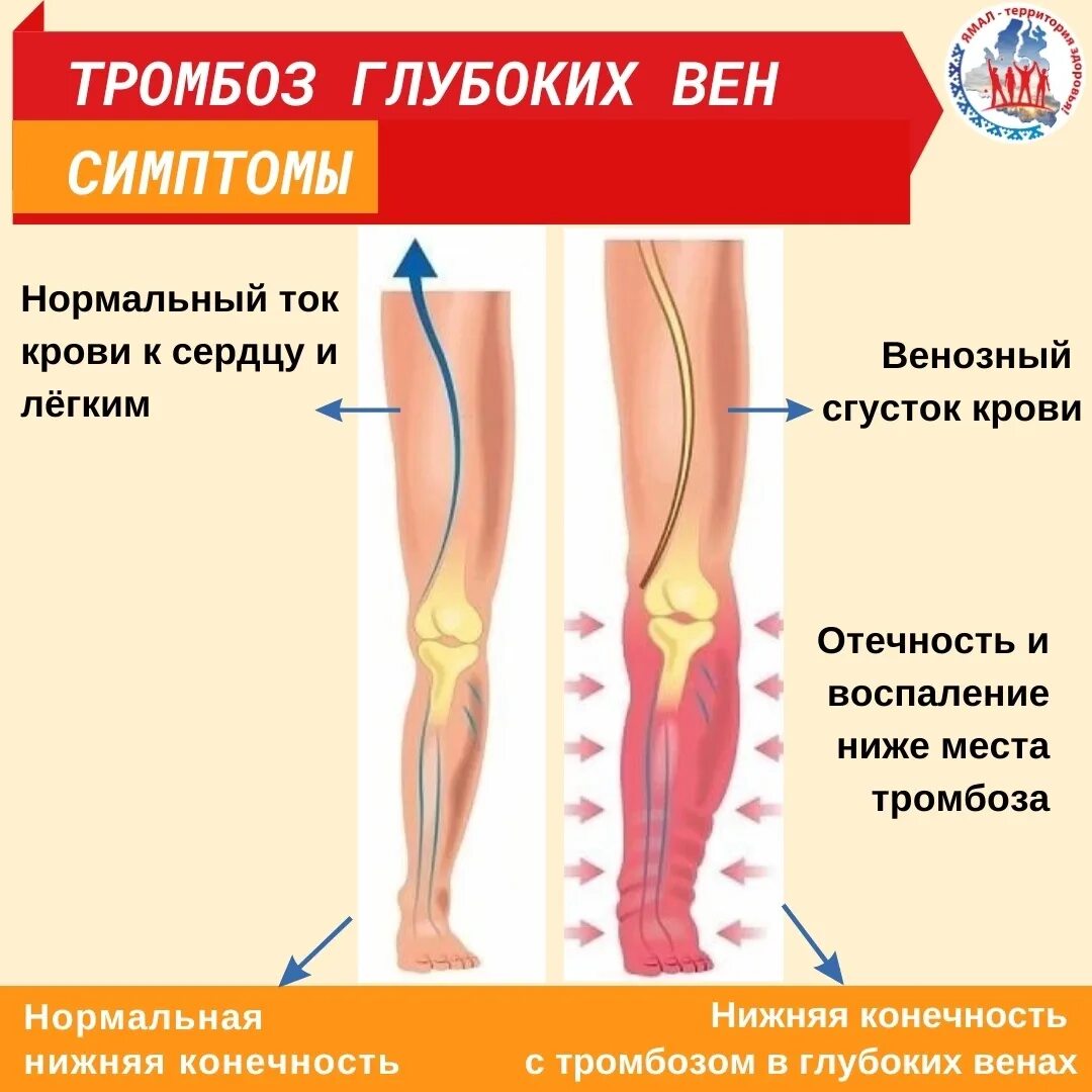 Поверхностный тромбофлебит нижних конечностей симптомы фото СЕГОДНЯ ВСЕМИРНЫЙ ДЕНЬ БОРЬБЫ С ТРОМБОЗОМ