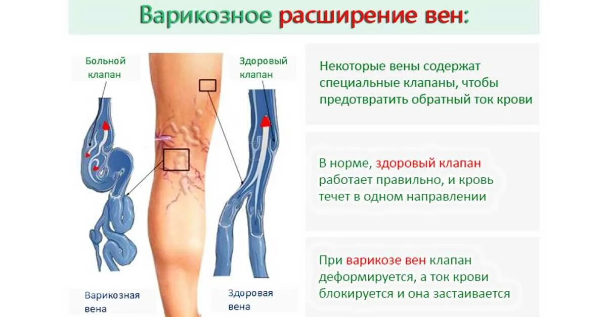 Поверхностный тромбофлебит нижних конечностей симптомы фото Почему прячутся вены: найдено 30 изображений