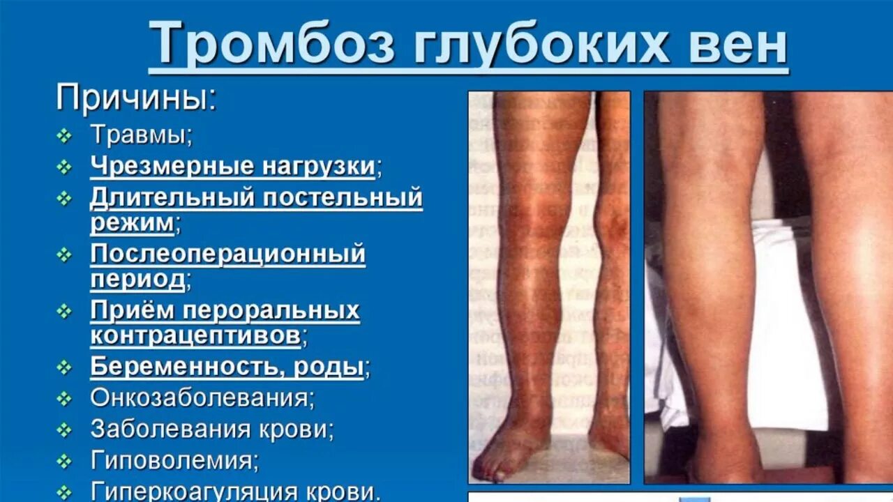 Поверхностный тромбофлебит нижних конечностей симптомы фото Признаки тромбоза нижних конечностей у женщин симптомы