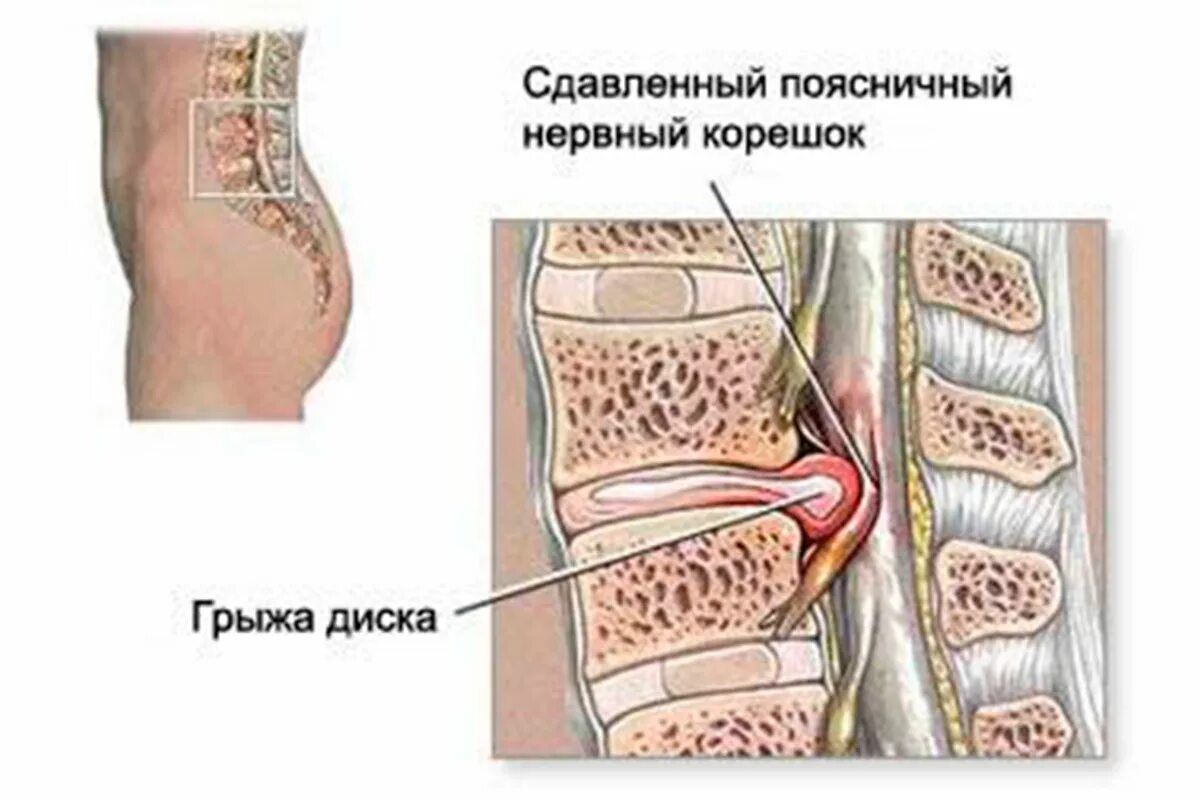 Поясничная грыжа симптомы и лечение фото Картинки ГРЫЖА В КРЕСТЦОВОМ ОТДЕЛЕ ПОЗВОНОЧНИКА