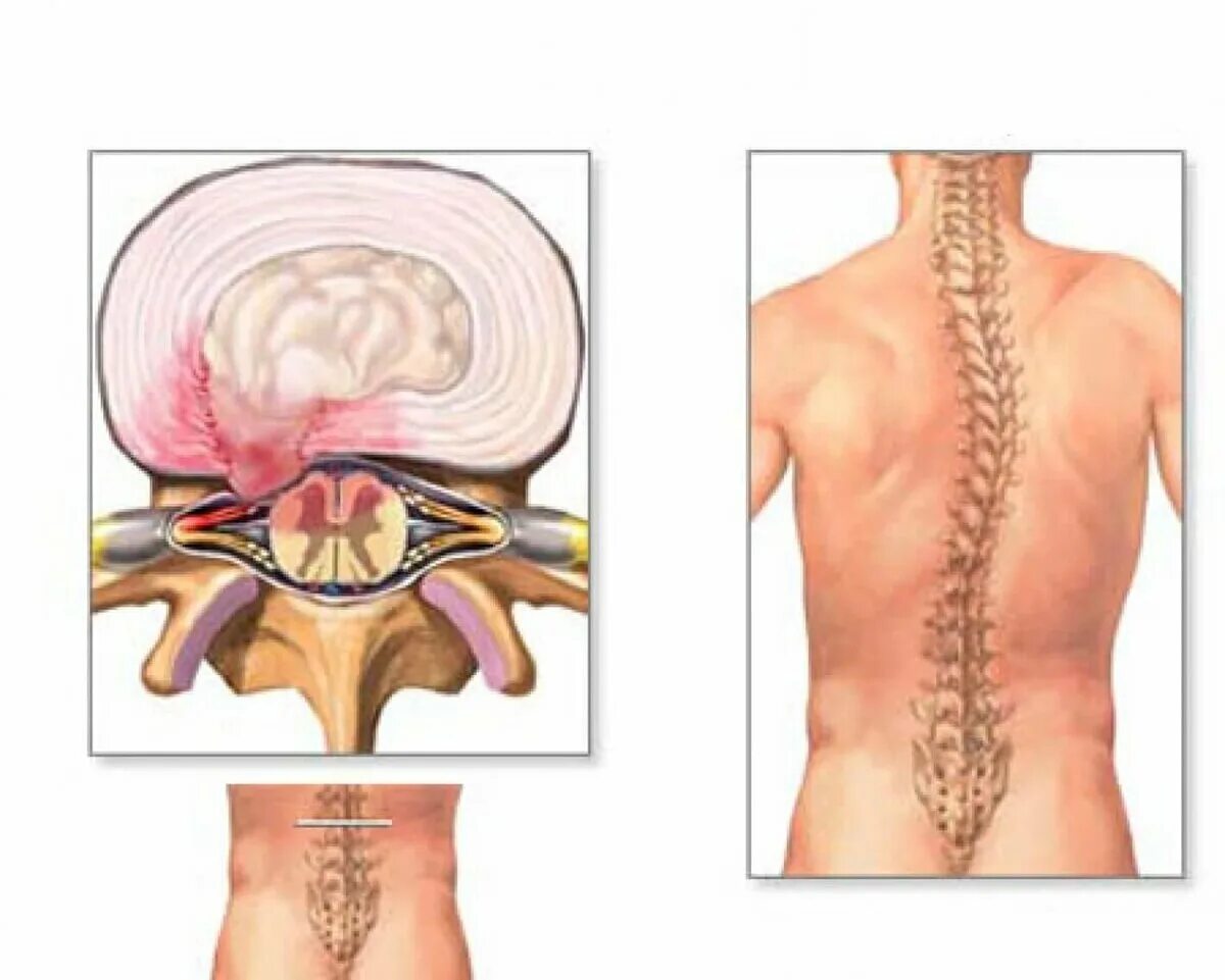 Грыжа пояснично-крестцового отдела позвоночника: симптомы, диагностика и лечения