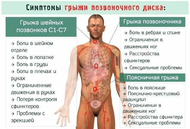 Поясничная грыжа симптомы и лечение фото Шейная грыжа у мужчин - не приговор МЦ Гармония