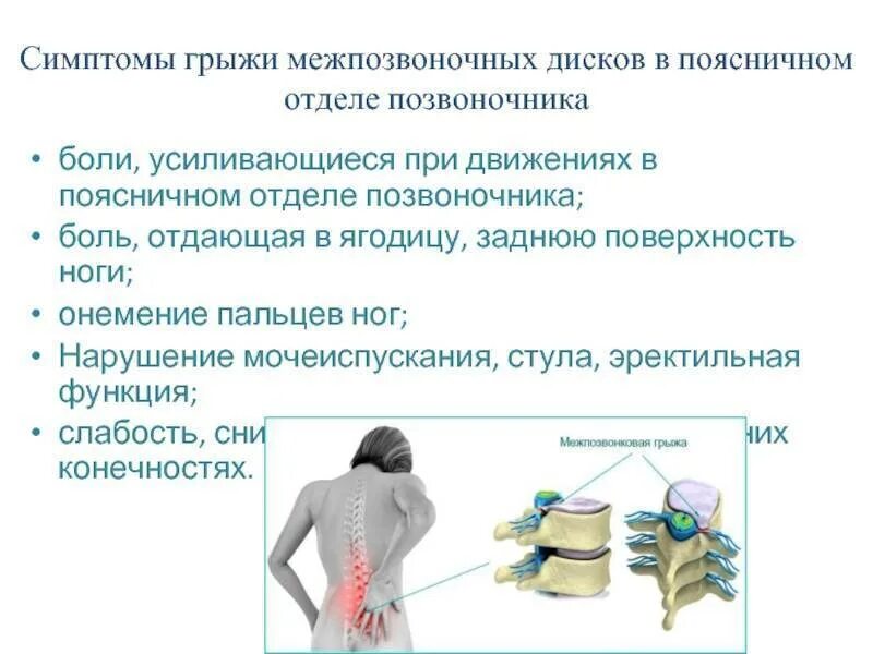 Поясничная грыжа симптомы и лечение фото Межпозвоночная грыжа поясничного отдела - Здоровье - Вопросы и ответы про йогу