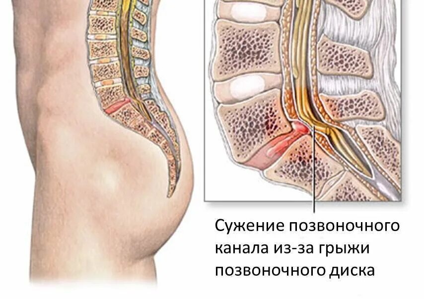 Поясничная грыжа симптомы и лечение фото Грыжа поясничного отдела правильное лечение. Врач Мануальный Терапевт Спб Дзен