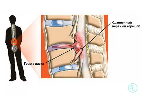 Поясничная грыжа симптомы у мужчин фото Грыжа межпозвоночного диска, операция по удалению в Москве, стоимость и цены