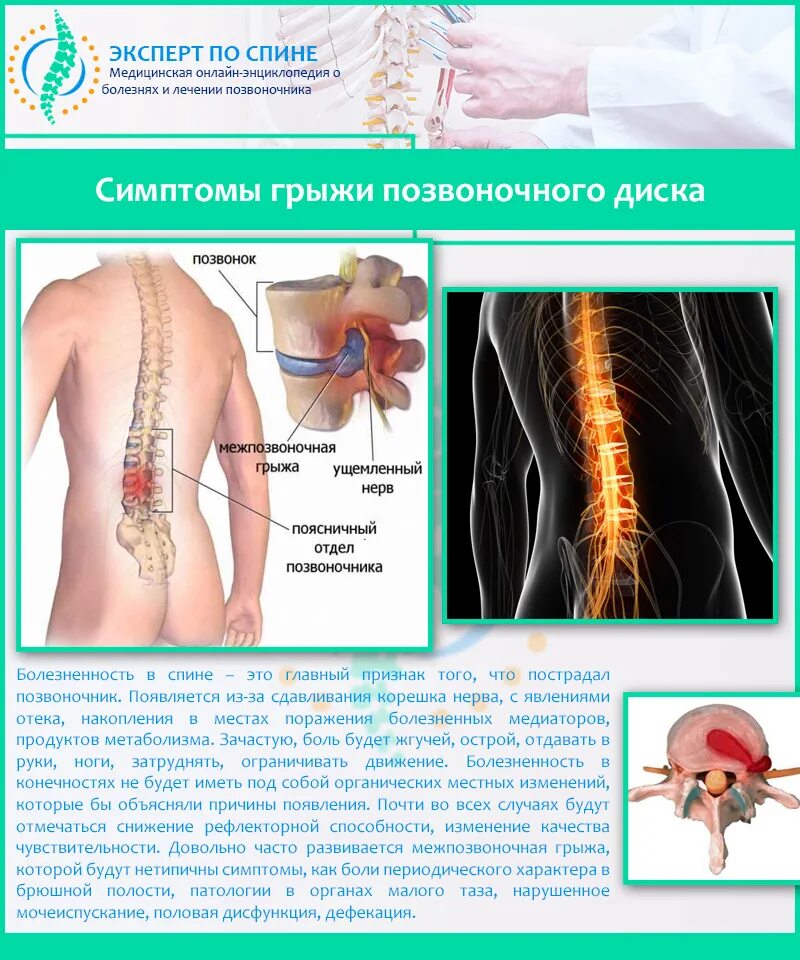 Поясничная грыжа симптомы у мужчин фото Блокада при грыже поясничного отдела позвоночника - какой бывает и для чего нужн