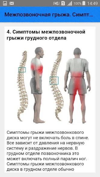 Поясничная грыжа симптомы у мужчин фото Межпозвоночная грыжа. Симптомы - Праграмы ў Google Play