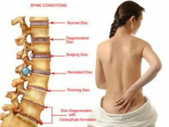 Поясничная грыжа симптомы у женщин фото Pin on Lower Back Pain