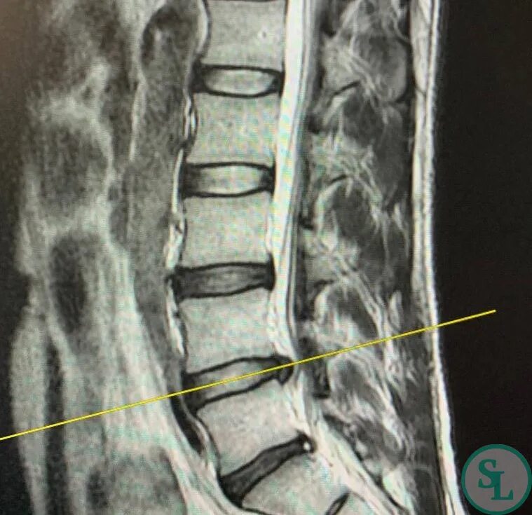 Поясничная грыжа симптомы у женщин фото Грыжа межпозвонкового диска L4-L5 слева