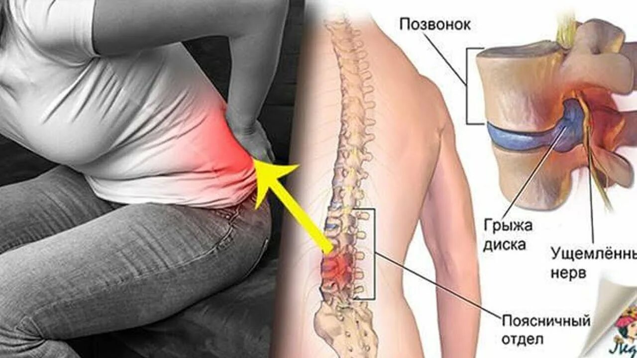 Поясничная грыжа симптомы у женщин фото Как болит межпозвонковая грыжа диска позвоночника