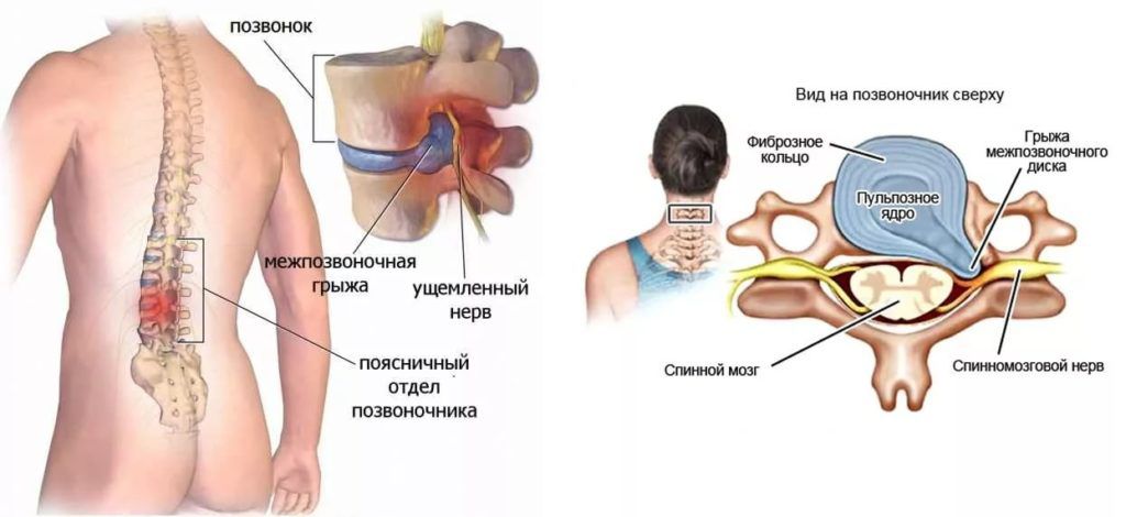 Поясничная грыжа симптомы у женщин фото Грыжа поясничного отдела позвоночника симптомы, лечение без операции в Москве