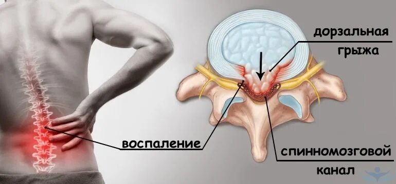 Поясничная грыжа симптомы у женщин фото Обострение грыжи поясничного отдела: лечение, симптомы в клиники Москвы