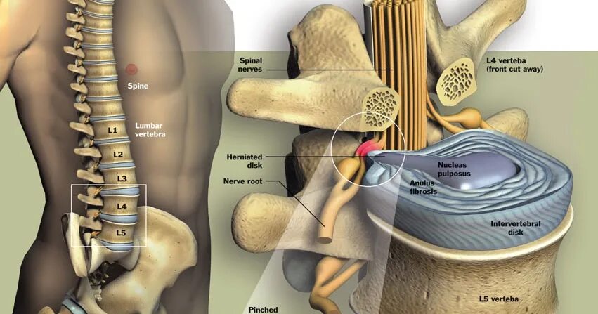 Поясничная грыжа симптомы у женщин фото Проходит ли грыжа позвоночника