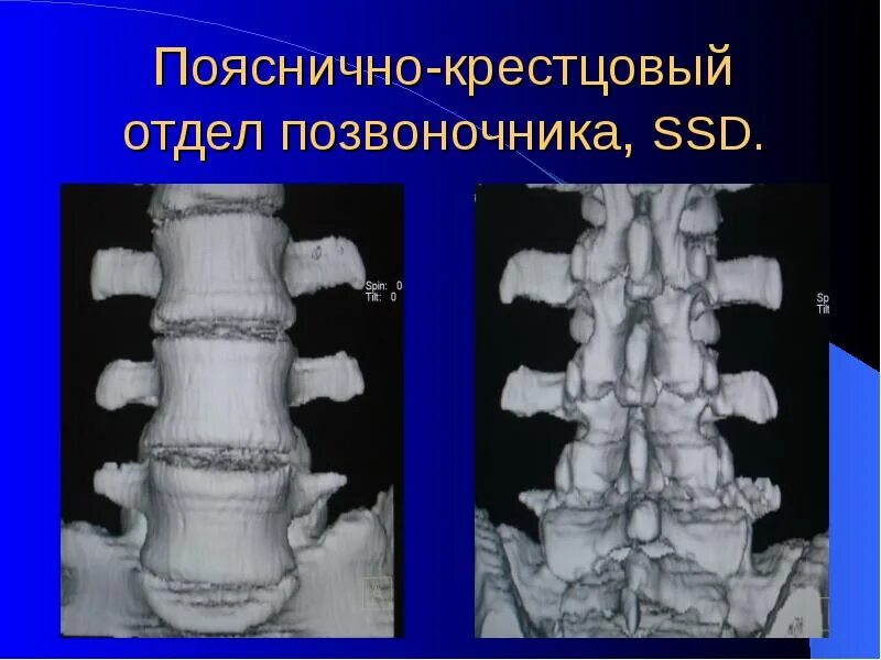 Пояснично крестцовый отдел позвоночника фото Пояснично крестцовый отдел позвонки