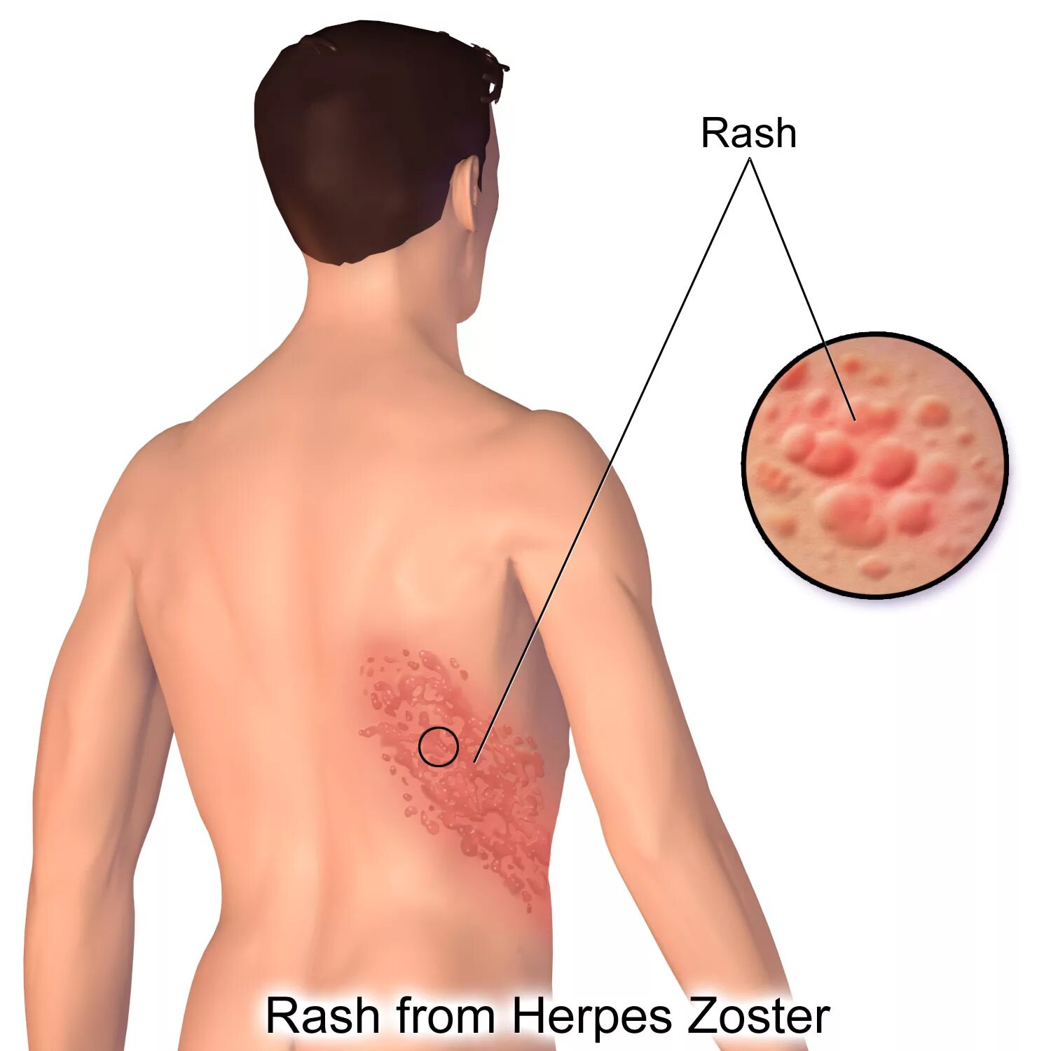 Поясничный герпес фото File:Herpes Zoster Rash.png - Wikimedia Commons