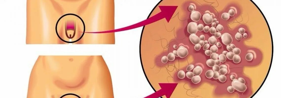 Поясничный герпес фото и лечение у мужчин Рак головки полового
