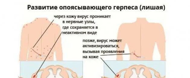 Поясничный герпес фото и лечение у мужчин Картинки ОПОЯСЫВАЮЩИЙ ГЕРПЕС НЕВРАЛГИЯ ЛЕЧЕНИЕ