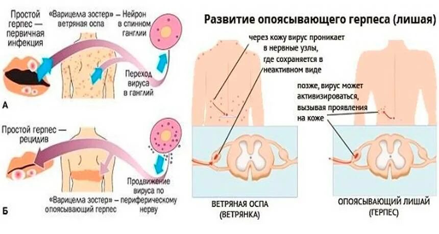 Поясничный герпес фото и лечение у мужчин Герпес на теле у ребенка: рекомендации педиатра и 6 этапов развития болезни