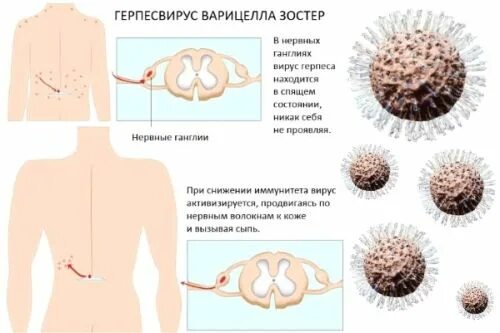 Поясничный герпес отчего появляется как лечить фото Поясничный герпес: причины, лечение и последствия