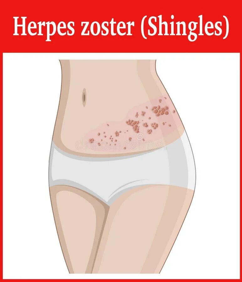 Поясничный герпес отчего появляется как лечить фото Illustration of Herpes Zoster Stock Vector - Illustration of infection, paunch: 