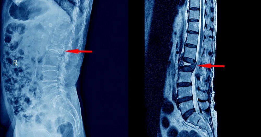 Поясничный отдел фото What is a Herniated Disc MRI, and When Do You Need It? - Dr. Kevin Pauza