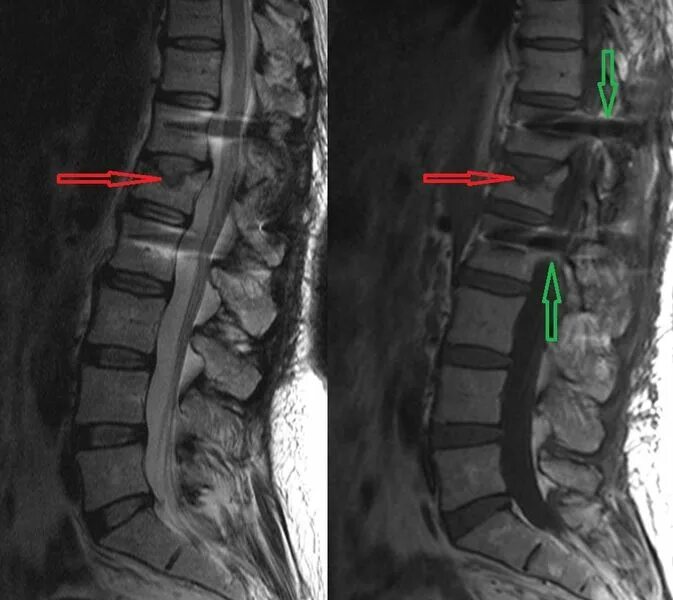 Поясничный отдел позвоночника фото на человеке МРТ позвоночника: что показывает и когда назначается. КТ или МРТ спины лучше