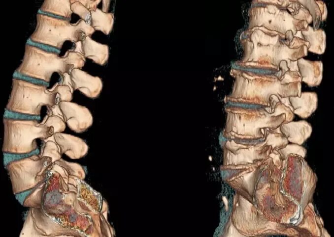 Поясничный отдел позвоночника фото на человеке Что покажет КТ поясничного отдел, особенности и преимущества компьютерной томогр