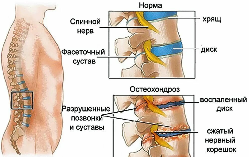 Поясничный отдел спины фото Неудачные попытки забеременеть и родить: патология позвоночника, диагностика и л