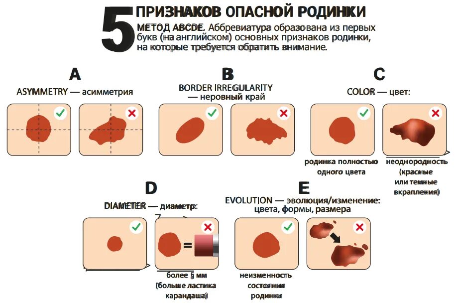 Появляются красные родинки фото Опасные родинки, как отличить и что делать. Арклиник Дзен