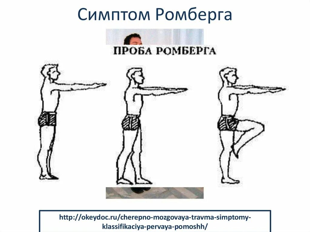 Поза ромберга что это такое фото Картинки ПРОБА РОМБЕРГА РЕЗУЛЬТАТЫ