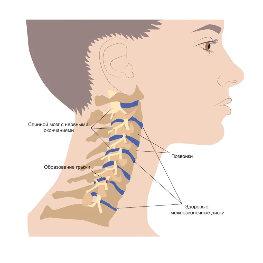Позвонки шейного отдела по номерам на фото Грыжа диска C4