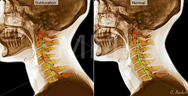 Позвонки шейного отдела позвоночника фото Color X Rays Cervical Spine Subluxation Before After Anatomie, Inka