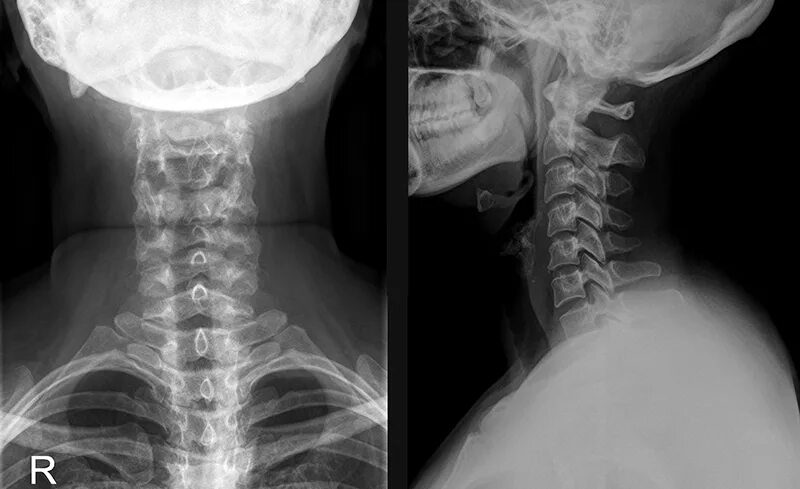 Позвонки шейного отдела позвоночника фото Рентгенография позвоночника