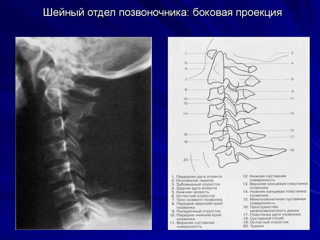 Позвонки шейного отдела позвоночника фото Отсутствие шейного отдела позвоночника